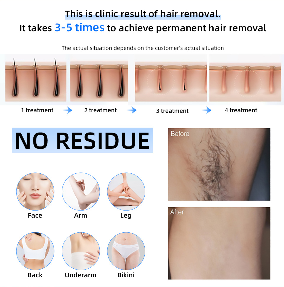 ราคาโรงงาน 20000000   Beat 808 - Laser Hair Removal Diode 808 บทวิจารณ์และราคา
