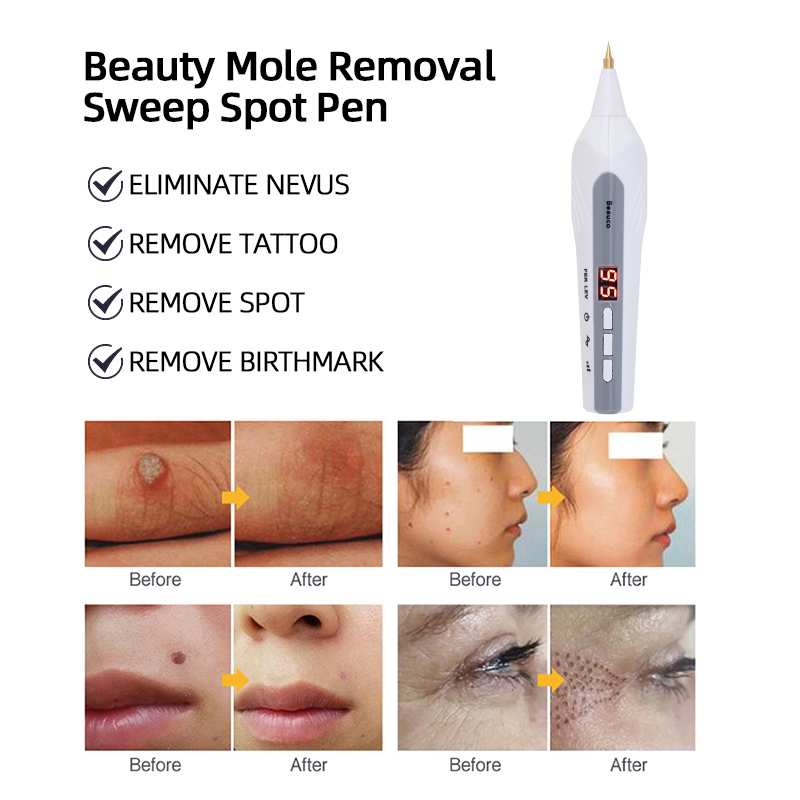 ปากกาลบไฝ ช่วยลบจุดด่างดำ ติ่ง - Plasma Mole Spot Removal Pen 9 Level บทวิจารณ์และราคา
