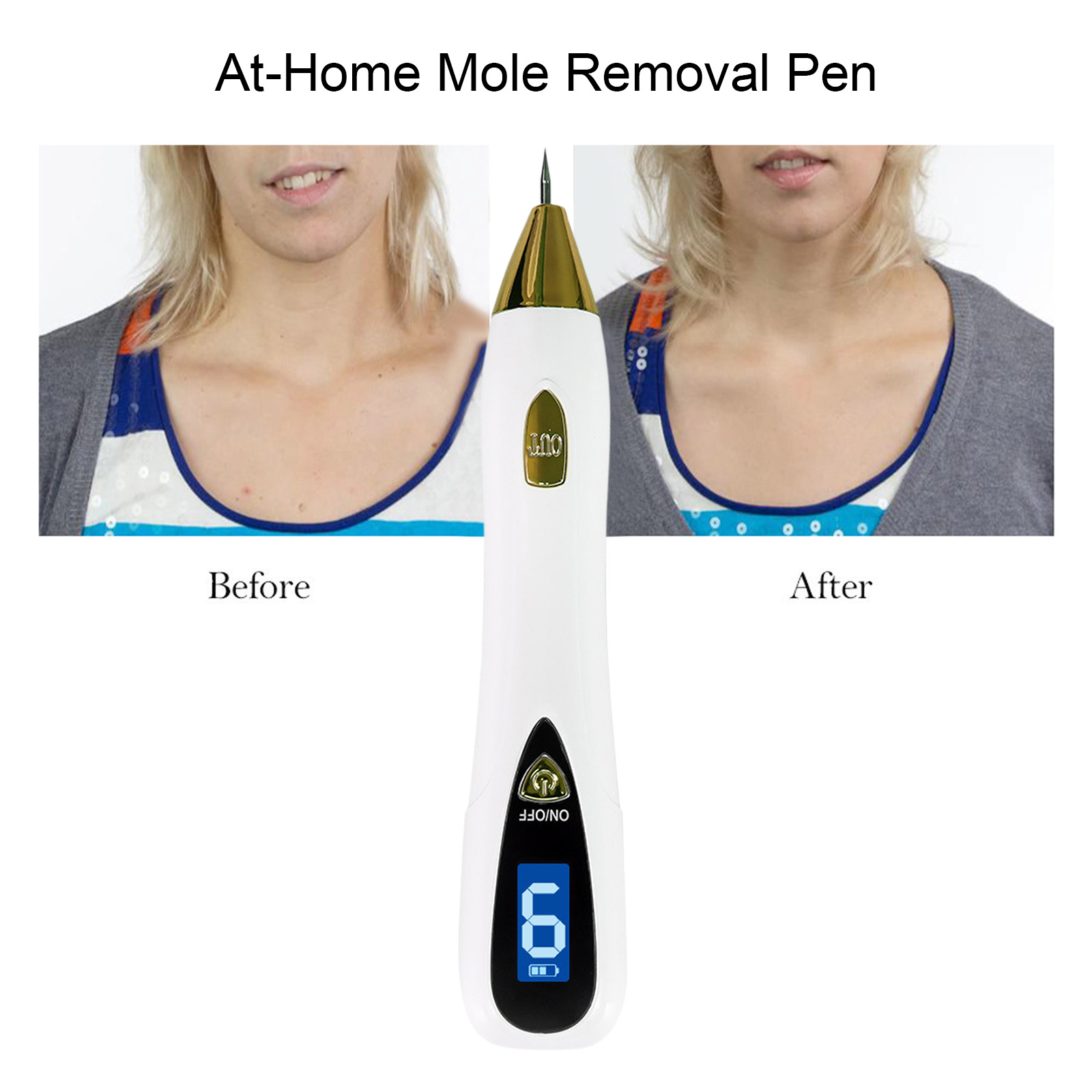 เครื่องมือกำจัดไฝและหูดระดับมื - Plasma Mole Spot Removal Pen 9 Level บทวิจารณ์และราคา